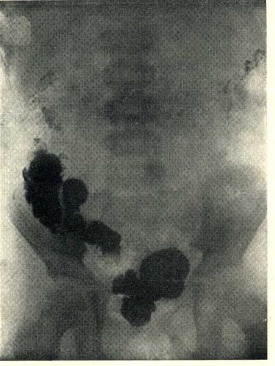 Рентгеновский снимок “Поражение толстого
кишечника при дизентерии”