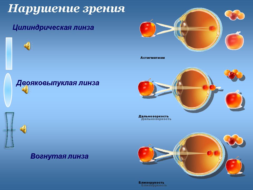 Линзы для зрения дальнозоркость. Линзы для близорукости двояковыпуклые. Нарушение зрения биология. Двояковыпуклая линза для дальнозоркости. Типы нарушения зрения.